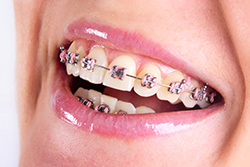 Ceramic tooth colored braces I Bruch Orthodontics, Great Falls, MT