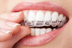 Clear aligners I Bruch Orthodontics, Great Falls, MT